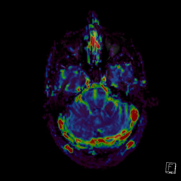 Central neurocytoma (Radiopaedia 84497-99872 Axial Perfusion 226).jpg
