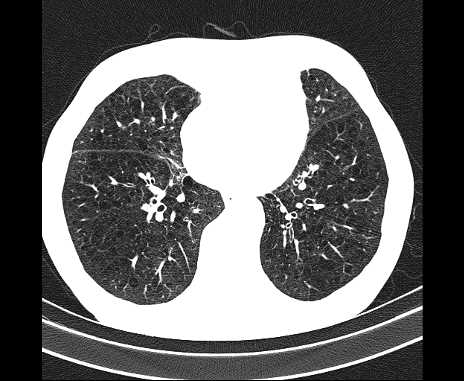 Centrilobular pulmonary emphysema (Radiopaedia 62468-70718 Axial lung window 52).jpg