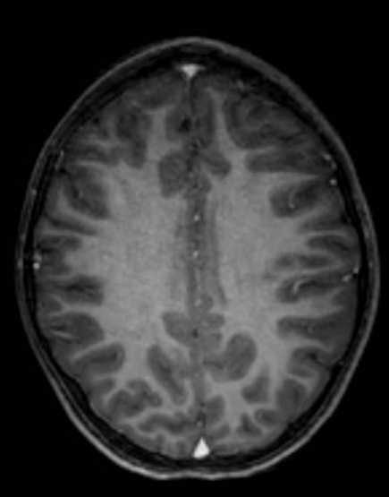 Cerebellar abscess (Radiopaedia 73727-84563 Axial T1 C+ fat sat 77).jpg