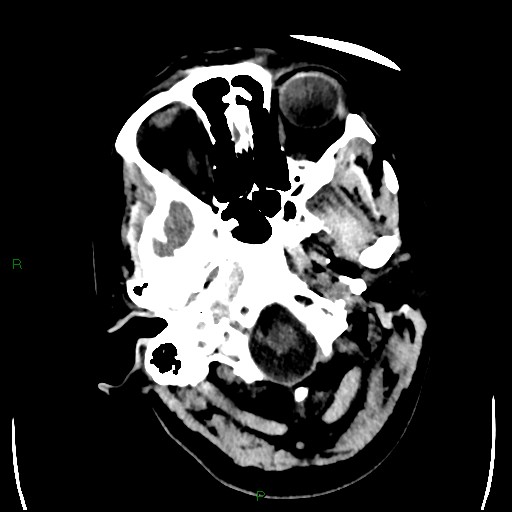 Cerebellar abscess (Radiopaedia 78135-90671 Axial non-contrast 13).jpg
