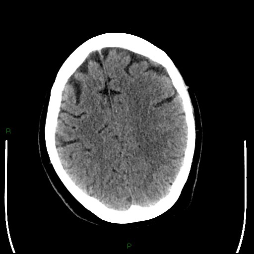 Cerebellar abscess (Radiopaedia 78135-90671 Axial non-contrast 79).jpg