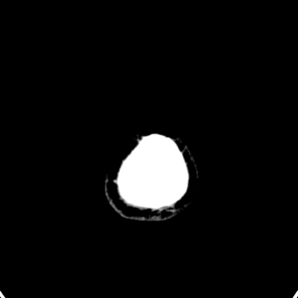 Cerebellar abscess secondary to mastoiditis (Radiopaedia 26284-26412 Axial non-contrast 157).jpg