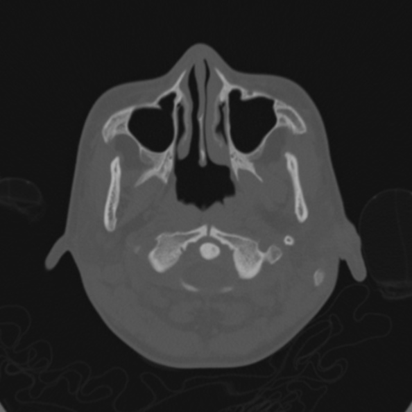 File:Cerebellar abscess secondary to mastoiditis (Radiopaedia 26284-26413 Axial bone window 6).jpg
