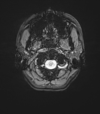Cerebellar agenesis with hypoplastic pons (pontocerebellar hypoplasia) (Radiopaedia 57224-64138 Axial SWI 4).png