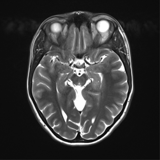 File:Cerebellar agenesis with hypoplastic pons (pontocerebellar hypoplasia) (Radiopaedia 57224-64138 Axial T2 17).png