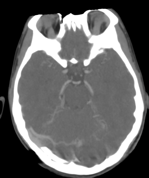 Cerebellar arteriovenous malformation- with hemorrhage (Radiopaedia 35752-37297 B 20).png