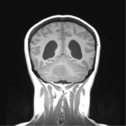 Cerebellar ependymoma complicated by post-operative subdural hematoma (Radiopaedia 83322-97736 Coronal T1 42).png