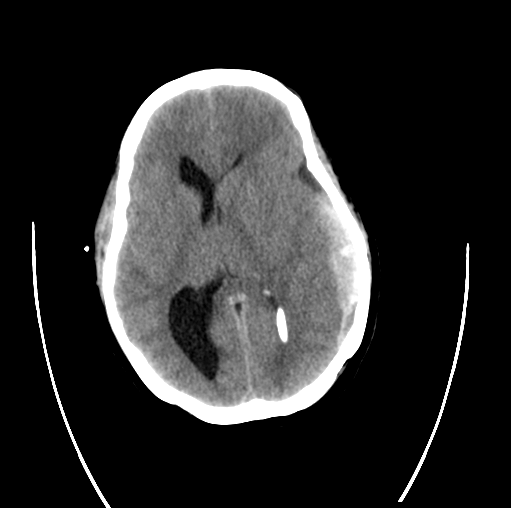 File:Cerebellar ependymoma complicated by post-operative subdural hematoma (Radiopaedia 83322-97737 C 1).png
