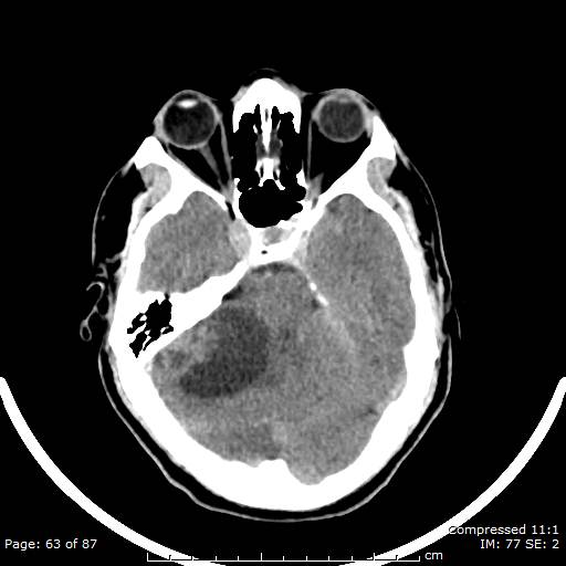 Cerebellar hemangioblastoma (Radiopaedia 52360-58258 Axial non-contrast 63).jpg
