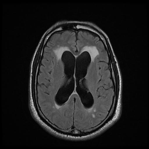 File:Cerebellar hemangioblastoma (Radiopaedia 88055-104622 Axial FLAIR 16).jpg