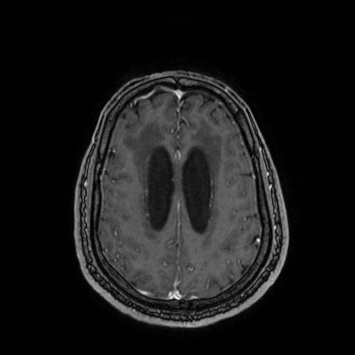 Cerebellar hemangioblastoma (Radiopaedia 88055-104622 Axial T1 C+ 128).jpg