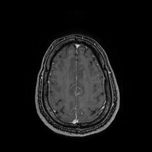 Cerebellar hemangioblastoma (Radiopaedia 88055-104622 Axial T1 C+ 141).jpg