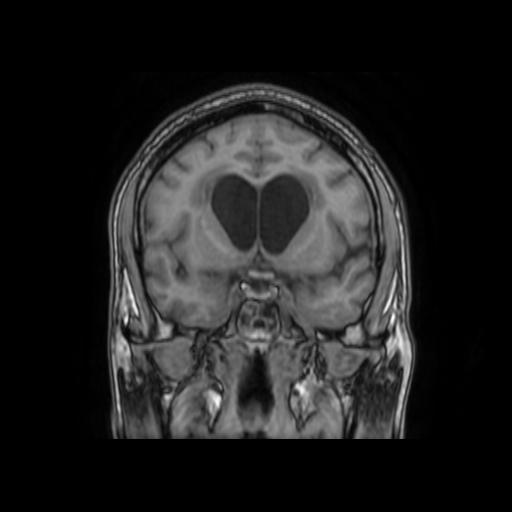 File:Cerebellar hemangioblastoma (Radiopaedia 88055-104622 Coronal T1 15).jpg