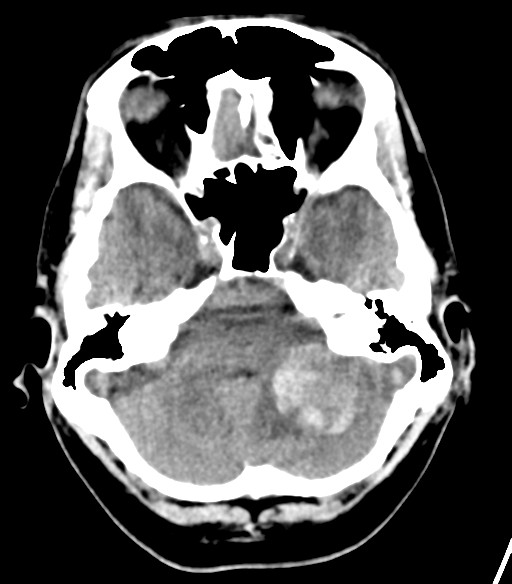 File:Cerebellar hemorrhage (Radiopaedia 37000-38669 Axial non-contrast 11).png