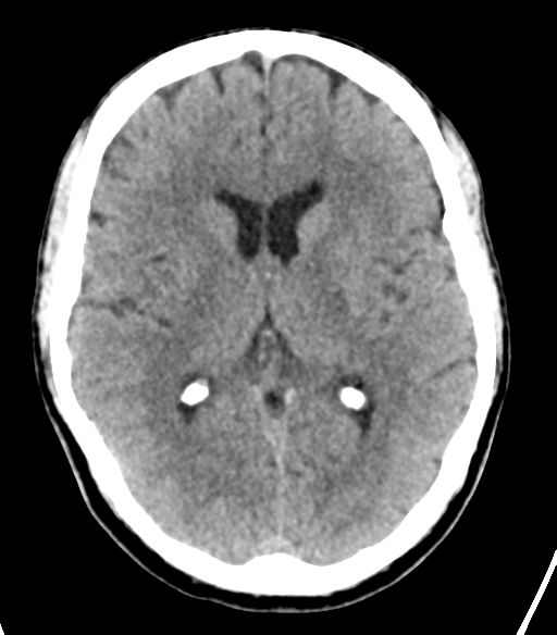File:Cerebellar hemorrhage (Radiopaedia 37000-38669 Axial non-contrast 21).png