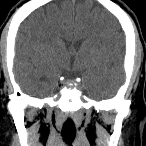 Cerebellar infarction (Radiopaedia 16625-16327 Coronal non-contrast 4).jpg