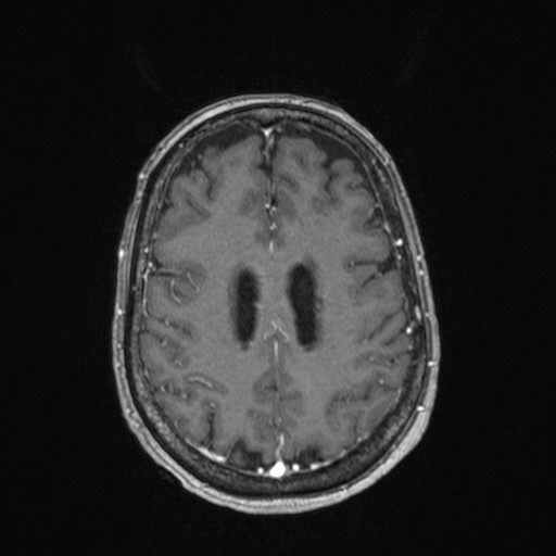 File:Cerebellar metastases (Radiopaedia 24038-24249 Axial T1 C+ 1).jpg