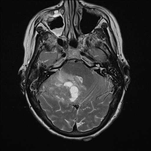 File:Cerebellar metastases (Radiopaedia 24038-24249 Axial T2 9).jpg