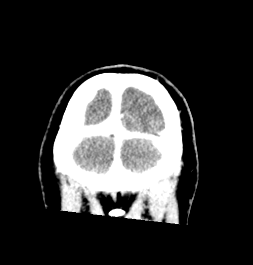 Cerebellar metastases - colorectal adenocarcinoma (Radiopaedia 40947-43652 Coronal C+ 84).png