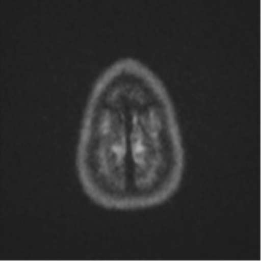 Cerebellar metastasis (Radiopaedia 51137-56765 Axial DWI 55).png