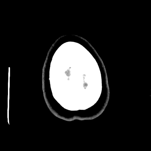 Cerebellar metastasis (cystic appearance) (Radiopaedia 41395-44258 Axial non-contrast 51).png