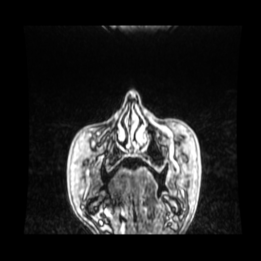 File:Cerebellar metastasis of pulmonary adenocarcinoma, cavernous venous malformation, and developmental venous anomaly (Radiopaedia 85827-101661 Coronal T1 C+ 95).jpg