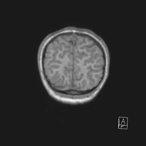 Cerebellar stroke (Radiopaedia 32202-33150 Coronal T1 56).png