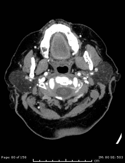 Cerebellar strokes due to intracranial giant cell arteritis (Radiopaedia 68799-78510 CT angiogram 80).jpg