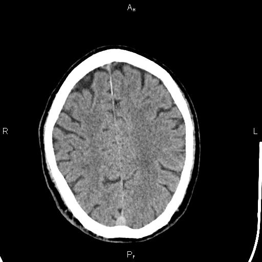 Cerebellopontine angle arachnoid cyst (Radiopaedia 85149-100704 Axial With contrast 37).jpg