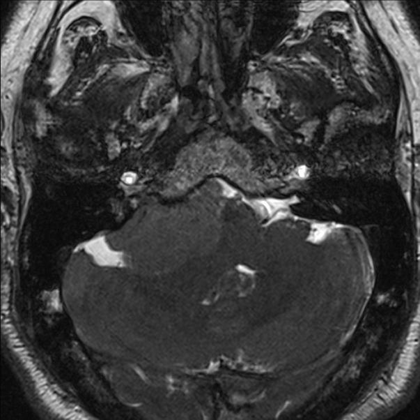 Cerebellopontine angle meningioma (Radiopaedia 24459-24764 I 17).jpg