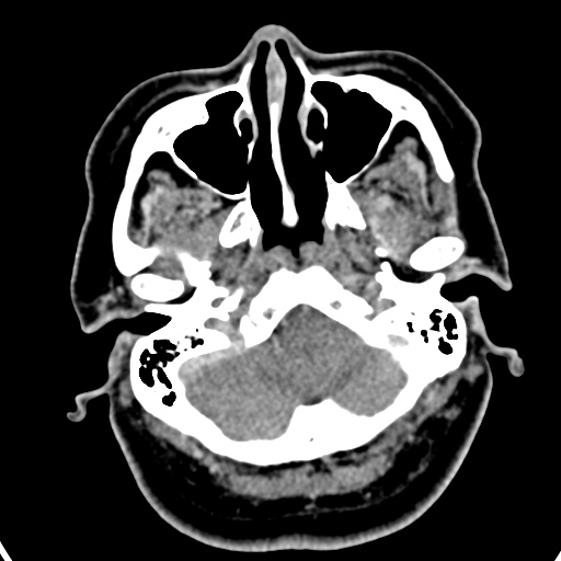 Cerebellopontine angle meningioma (Radiopaedia 35181-36714 A 46).jpg
