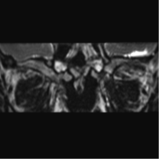 Cerebellopontine angle meningioma (Radiopaedia 48434-53348 Coronal T2 88).png