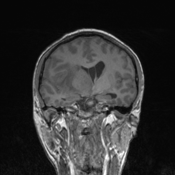 Cerebral abscess (Radiopaedia 24212-24478 Coronal T1 106).jpg