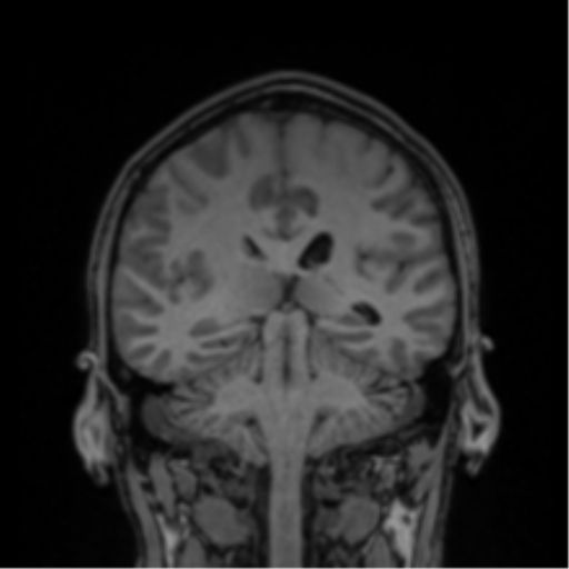 Cerebral abscess (Radiopaedia 60342-68009 Coronal T1 18).png