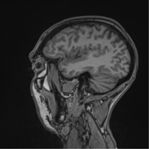 Cerebral abscess (Radiopaedia 60342-68009 Sagittal T1 16).png