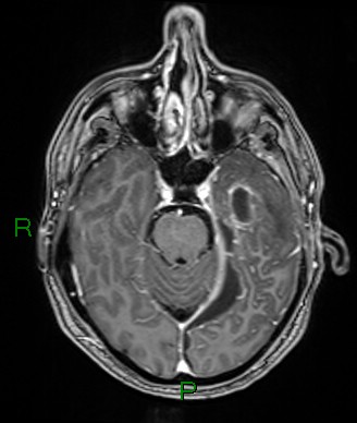 Cerebral abscess and subdural empyema (Radiopaedia 84436-99779 Axial T1 C+ 58).jpg