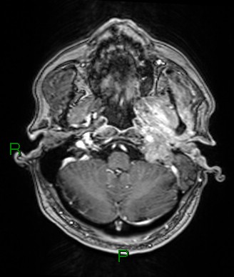 Cerebral abscess and subdural empyema (Radiopaedia 84436-99779 Axial T1 C+ 72).jpg