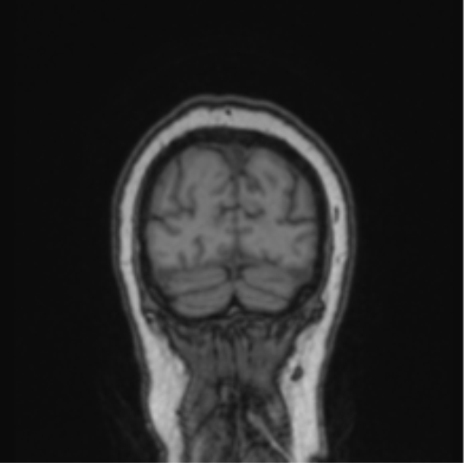 Cerebral abscess from pulmonary arteriovenous malformation (Radiopaedia 86275-102291 Coronal T1 14).png