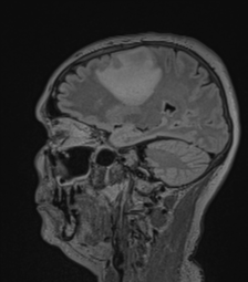 Cerebral abscess from pulmonary arteriovenous malformation (Radiopaedia 86275-102291 Sagittal FLAIR 47).png