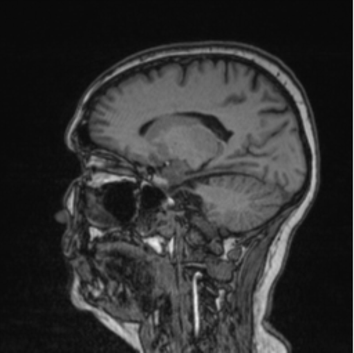 Cerebral abscess from pulmonary arteriovenous malformation (Radiopaedia 86275-102291 Sagittal T1 45).png