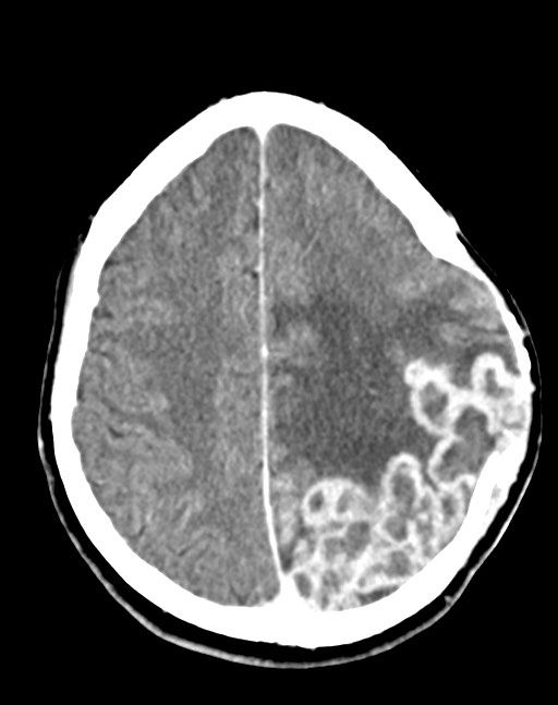 Cerebral abscesses (Radiopaedia 70458-80568 Axial Contrast 44).jpg