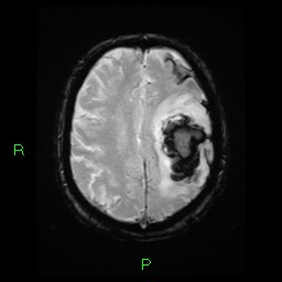 File:Cerebral amyloid angiopathy-associated lobar intracerebral hemorrhage (Radiopaedia 58376-65512 Axial Gradient Echo 8).jpg