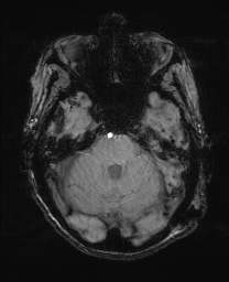 File:Cerebral amyloid angiopathy-related inflammation (Radiopaedia 74836-85849 Axial SWI 21).jpg