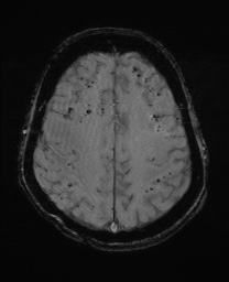 Cerebral amyloid angiopathy-related inflammation (Radiopaedia 74836-85849 Axial SWI 52).jpg