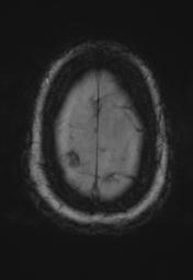 File:Cerebral amyloid angiopathy (Radiopaedia 29129-29518 Axial SWI Magnitude 34).jpg