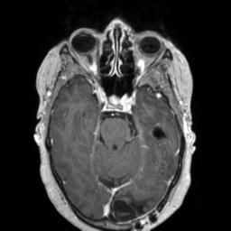 File:Cerebral amyloid angiopathy (Radiopaedia 29129-29518 Axial T1 C+ 53).jpg