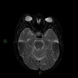 Cerebral amyloid angiopathy (Radiopaedia 77506-89664 Axial DWI 39).jpg