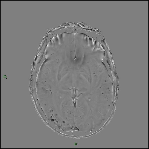 Cerebral amyloid angiopathy (Radiopaedia 77506-89664 H 51).jpg