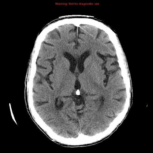 File:Cerebral and orbital tuberculomas (Radiopaedia 13308-13310 Axial non-contrast 33).jpg