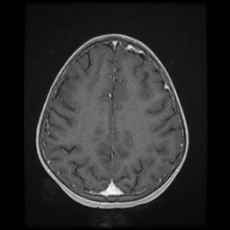 Cerebral and spinal tuberculosis (Radiopaedia 90489-107837 Axial T1 C+ 139).jpg